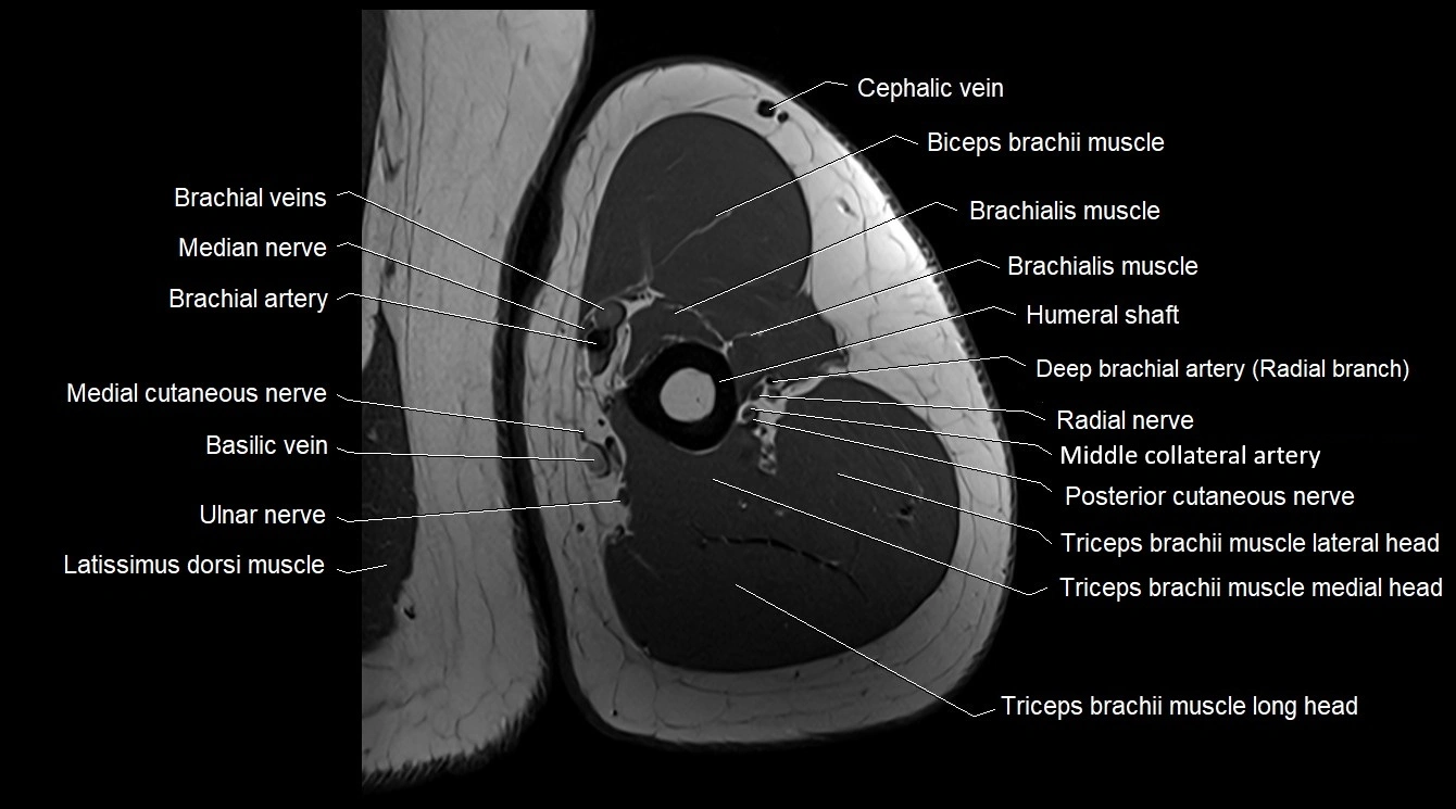 Upper arm( humerus) cross section anatomy MRI 3T axial image 36.webp